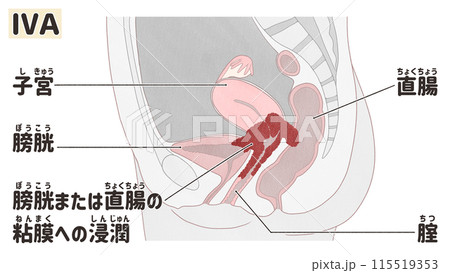 子宮頸がんステージⅣA（4A期）　わかりやすい日本語図解イラスト 115519353