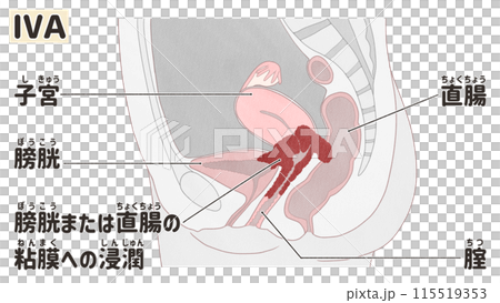 子宮頸がんステージⅣA（4A期）　わかりやすい日本語図解イラスト 115519353