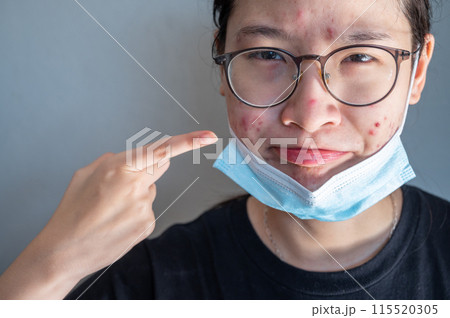 Young Asian woman open her mask and pointing acne problem occur on her skin caused of wearing mask for longtime. 115520305