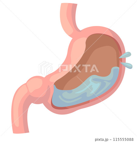 胃液がたくさんあふれ出る胃袋の中 胃液がたくさんあふれ出る胃袋の中 115555088
