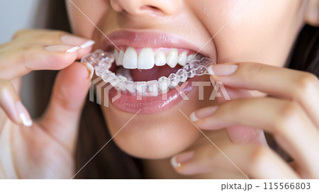 A woman puts on an invisible silicone aligner for her teeth. Bite Correction Braces Orthodontic Silicone Transparent Teeth Aligner 115566803