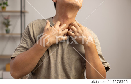 Senior man itchy and scratching arm and legs because dry skin. 115578393