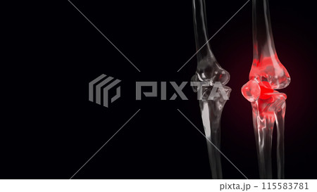 The Bone crystal for Osteoarthritis of the knee concept 3d rendering. The Bone crystal for Osteoarthritis of the knee concept 3d rendering. 115583781