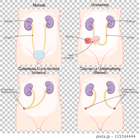 尿路ストーマ、ストーマ、ウロストミー、urostomy、オストメイト、小腸、膀胱、イラスト 尿路ストーマ、ストーマ、ウロストミー、urostomy、オストメイト、小腸、膀胱、イラスト 115584444