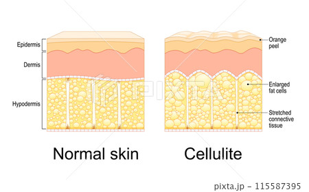 Cellulite formation. Orange peel syndrome 115587395