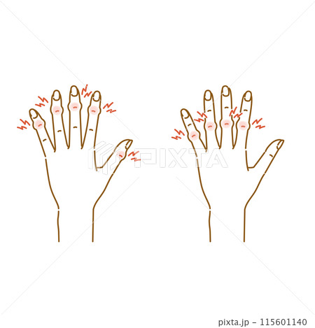 女性の更年期障害:指の関節の痛み・腫れ・変形(へバーデン結節・ブシャール結節) 女性の更年期障害:指の関節の痛み・腫れ・変形(へバーデン結節・ブシャール結節) 115601140