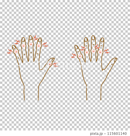 女性の更年期障害:指の関節の痛み・腫れ・変形(へバーデン結節・ブシャール結節) 女性の更年期障害:指の関節の痛み・腫れ・変形(へバーデン結節・ブシャール結節) 115601140