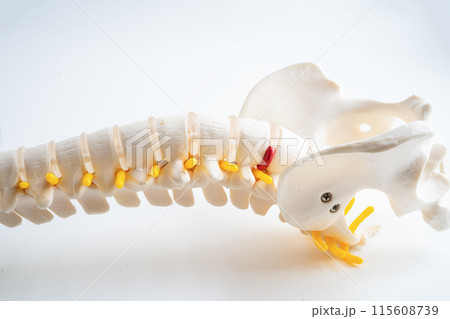 Lumbar spine displaced herniated disc fragment, spinal nerve and bone. Model for treatment medical in the orthopedic department. Lumbar spine displaced herniated disc fragment, spinal nerve and bone. Model for treatment medical in the orthopedic department. 115608739