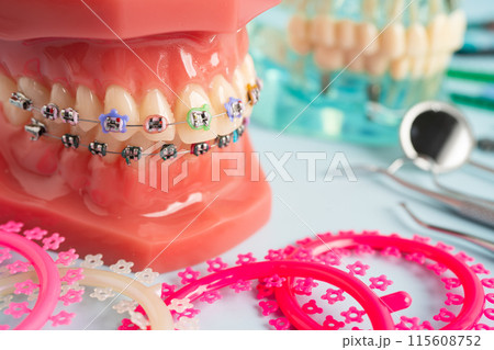 Orthodontic ligatures rings and ties, elastic rubber bands on orthodontic braces, model for dentist studying about dentistry. Orthodontic ligatures rings and ties, elastic rubber bands on orthodontic braces, model for dentist studying about dentistry. 115608752