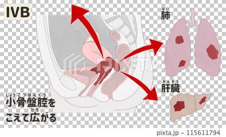 子宮頸がんステージⅣB（4B期）　わかりやすい日本語図解イラスト 115611794