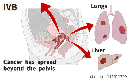 子宮頸がんステージⅣB(4B期) わかりやすい英語図解イラスト 子宮頸がんステージⅣB(4B期) わかりやすい英語図解イラスト 115611799