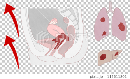 子宮頸癌IVB期(4B期) 簡單易懂的圖解 子宮頸癌IVB期(4B期) 簡單易懂的圖解 115611801