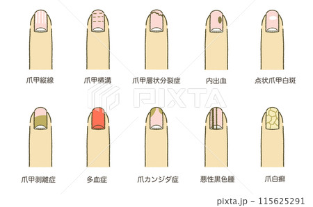 爪の症状一覧 爪の病気一覧 イラスト素材 115625291