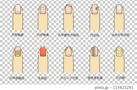 List of nail symptoms List of nail diseases Illustration material 115625291