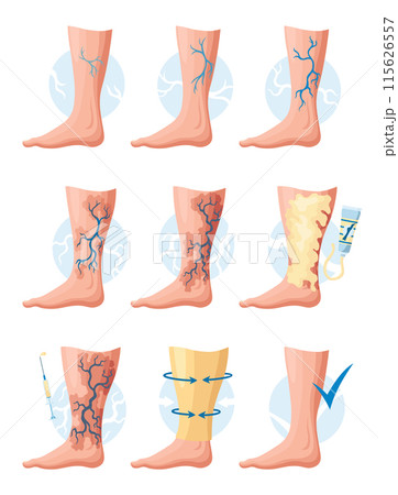 Stages or types of varicose veins development. Medical poster or disease infographic. Image of healthy and diseased legs. Vector illustration in flat style Stages or types of varicose veins development. Medical poster or disease infographic. Image of healthy and diseased legs. Vector illustration in flat style 115626557