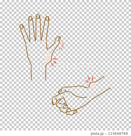 Menopausal symptoms in women: pain, swelling, and deformation of finger joints (thumb CM joint arthropathy, De Quervain's disease) 115648749