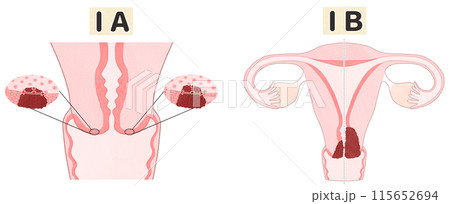 子宮頸がんステージ1（ⅠA・ⅠB）　わかりやすい図解イラスト 115652694