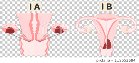 子宮頸がんステージ1（ⅠA・ⅠB）　わかりやすい図解イラスト 115652694