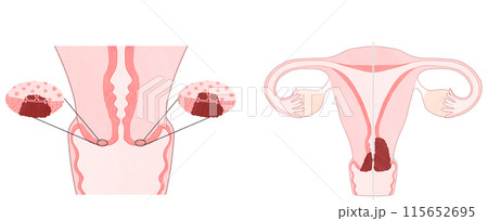子宮頸がんステージ1(ⅠA・ⅠB) わかりやすい図解イラスト 子宮頸がんステージ1(ⅠA・ⅠB) わかりやすい図解イラスト 115652695