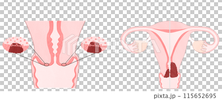 子宮頸がんステージ1(ⅠA・ⅠB) わかりやすい図解イラスト 子宮頸がんステージ1(ⅠA・ⅠB) わかりやすい図解イラスト 115652695