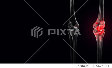 The Bone crystal for Osteoarthritis of the knee concept 3d rendering. 115674084