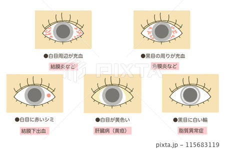 目の異常 目の病気 目の症状のイラストのイラスト素材 [115683119] - PIXTA