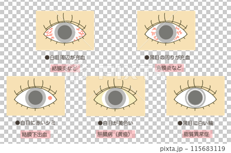 Eye abnormalities, eye diseases, eye symptoms illustrations Eye abnormalities, eye diseases, eye symptoms illustrations 115683119