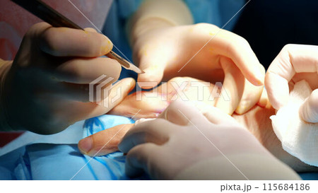Surgeons team conduct surgical operation in contemporary hospital close up to hands. Expertise coordination modern medical practices cutting-edge technologies employed within hospital environment. Surgeons team conduct surgical operation in contemporary hospital close up to hands. Expertise coordination modern medical practices cutting-edge technologies employed within hospital environment. 115684186