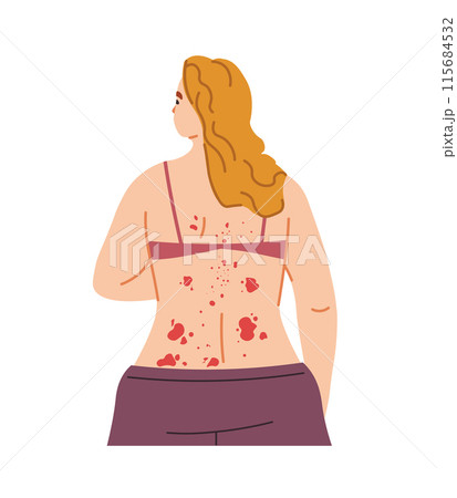 Woman with Back Rash Illustration Woman with Back Rash Illustration 115684532