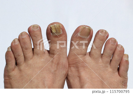 足の指 足の指 115700795
