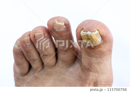 変色した足の親指の爪 115700798