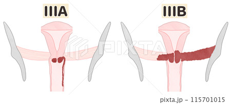 子宮頸がんステージ3（ⅢA・ⅢB）　わかりやすい図解イラスト 115701015