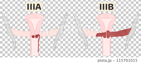 子宮頸がんステージ3（ⅢA・ⅢB）　わかりやすい図解イラスト 115701015
