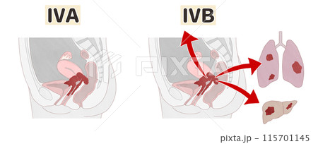 子宮頸がんステージ4（ⅣA・ⅣB）　わかりやすい図解イラスト 115701145