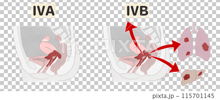 子宮頸がんステージ4（ⅣA・ⅣB）　わかりやすい図解イラスト 115701145