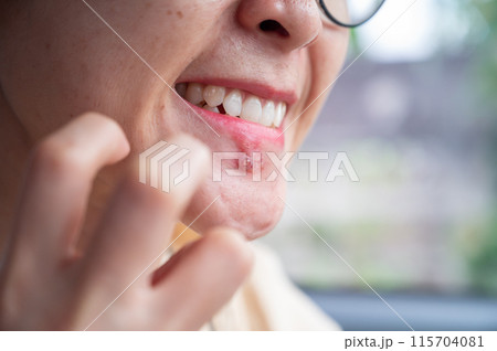 Woman having Itching cause of Herpes blisters that break open and form small ulcers, swollen lymph nodes. Herpes simplex virus is an infection that causes herpes. 115704081
