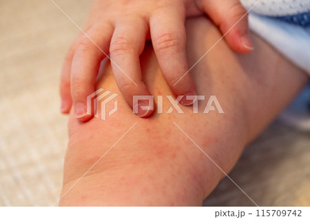 手足口病にかかった赤ちゃんの手足 手足口病にかかった赤ちゃんの手足 115709742