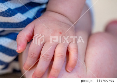 手足口病にかかった赤ちゃんの手足 手足口病にかかった赤ちゃんの手足 115709753