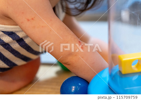 手足口病にかかった赤ちゃんの手 115709759