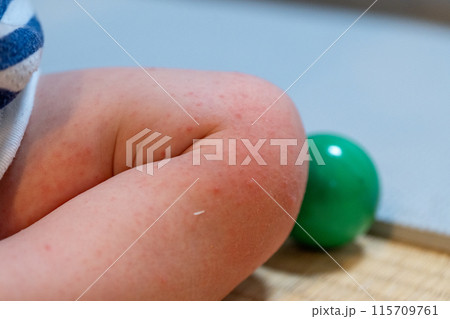 手足口病にかかった赤ちゃんの足 手足口病にかかった赤ちゃんの足 115709761