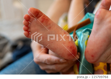 手足口病にかかった赤ちゃんの足 115709768