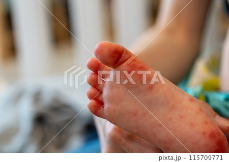 手足口病にかかった赤ちゃんの足 手足口病にかかった赤ちゃんの足 115709771