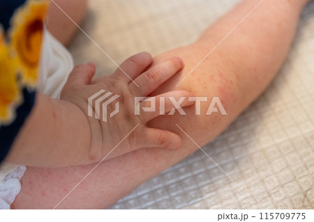 手足口病にかかった赤ちゃんの手足 115709775