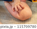 手足口病にかかった赤ちゃんの手足 115709780