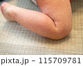 手足口病にかかった赤ちゃんの足 115709781