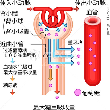 腎小体　糖尿　イラスト　中国語 115753092