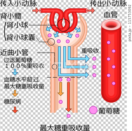 腎小体　糖尿　イラスト　中国語 115753092