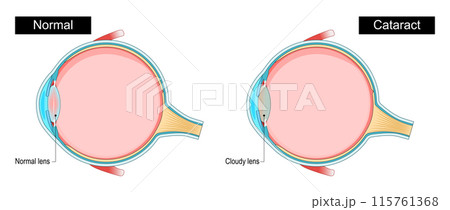 Cataract. Cross section of a human eye 115761368