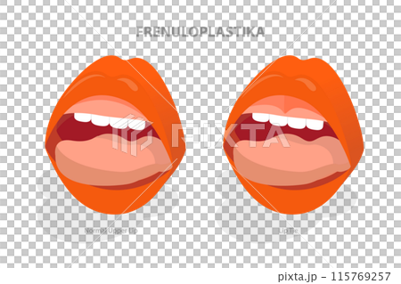 3D Isometric Flat Illustration of Frenuloplastika, Lip Tie Before and After Surgery 3D Isometric Flat Illustration of Frenuloplastika, Lip Tie Before and After Surgery 115769257