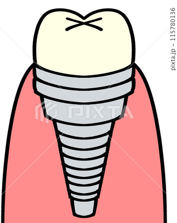 シンプルなインプラントの歯イラスト素材 115780136